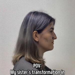 A side profile of the woman before surgery, showing her natural features, taken during the initial stage of her transformation journey.