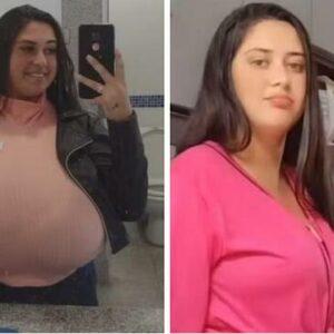 From Burden to Bravery: Thaynara Marcondes’ Journey Through Gigantomastia and Recovery